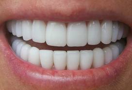 UploadImage/15308Full-mouth.jpg