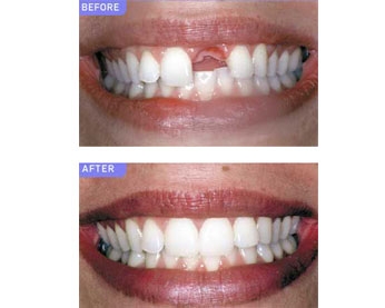 UploadImage/68571dental-thoot spot.jpg