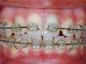 UploadImage/77860Orthodontic.jpg